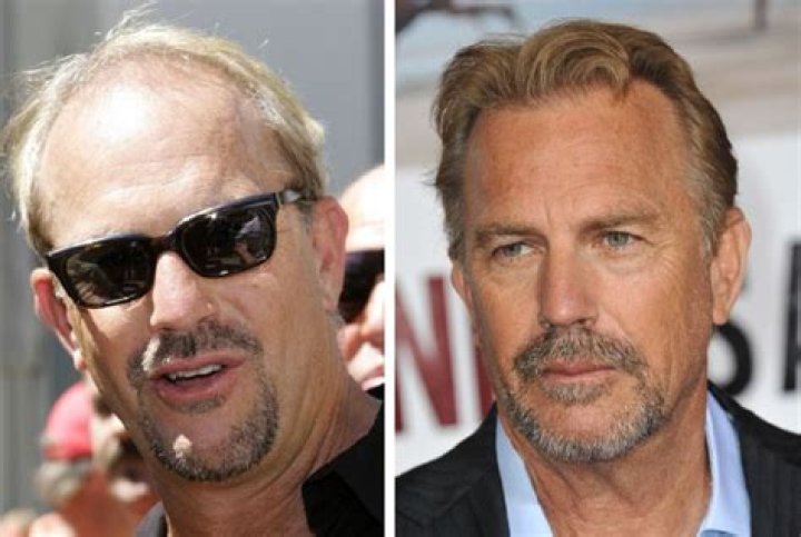 What Happened To Kevin Costner’s Left Ear? Does He Have A Ear Cancer?